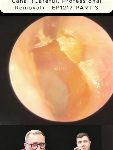 Hard Dry Skin Peel Inside The Ear Canal (Careful, Professional Removal) - EP1217 (3)#DRY #HARD #PEEL #CANAL