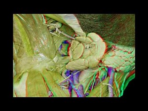 Head and Neck Anatomy for Neurosurgeons (3D Anaglyph)