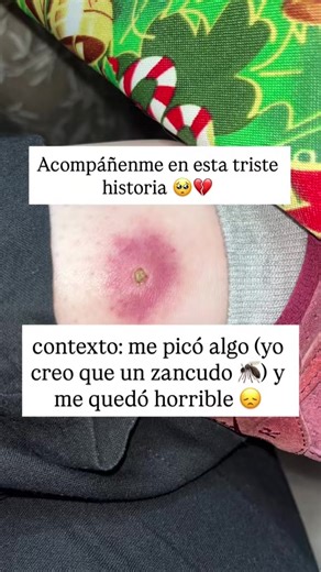 Consejos para el cuidado de picaduras de insectos en Chile