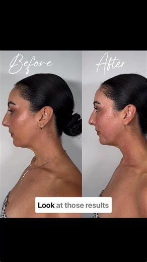 👉"I kept hearing about T-Shape 2 and finally decided to try it - and I’m so glad I did" This is the treatment that tightened my jawline and gave me my confidence back. If you’re doing all the right things but still noticing sagging around the jawline, chin, or neck, this is worth knowing about. T-Shape 2 is an advanced, non-surgical facial treatment designed to help: ✨ Tighten and firm the jawline ✨ Reduce the appearance of a double chin ✨ Improve skin firmness and elasticity ✨ Support natural 