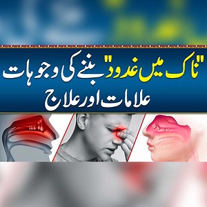 1.6M views · 7.8K reactions | Nasal Polyps Ka ilaj - Naak Mein Gadood Ka ilaj - Naak Ka Gosht Barh Jana Aur ilaj - Nose Care Tips #NasalPolypsTreatment #NasalHealth #NasalPolyps | Sehat Mand - Health & Lifestyle | Facebook