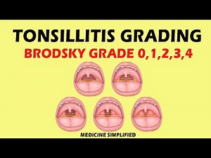 Tonsillitis Grading | Brodsky grading scale (Grade 0,1,2,3,4) #medicine