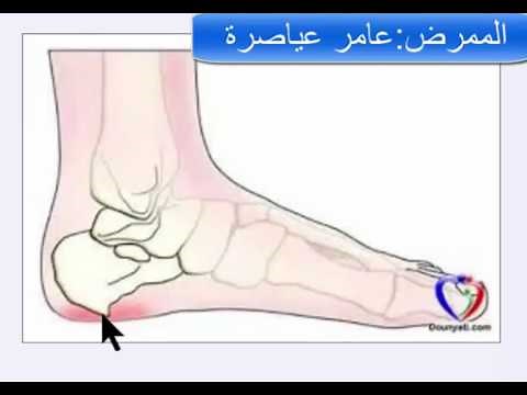 Heel spur: Causes and treatment - a comprehensive and simplified guide