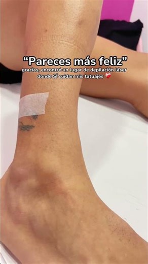 ¿Cómo tratan las pieles que tienen tatuajes en la depilación láser?