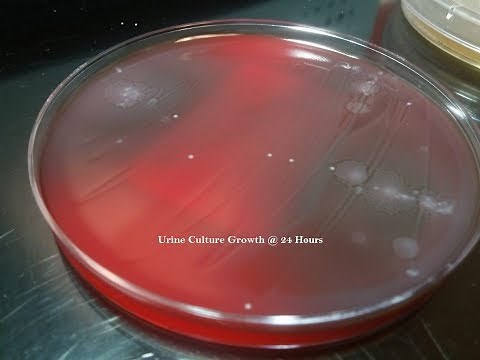 Urine Culture Colony Growth with Multiple Bacteria!