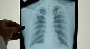 ¿Qué es la tuberculosis y cómo debe atenderse? Esto dice el IMSS