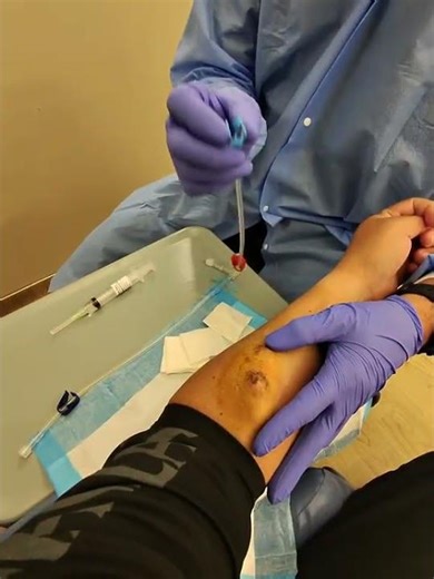 The Process of Dialysis' El Proceso de Dialysis'