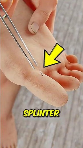If You Get a Splinter, This Simple Trick Works Better Than Pulling It Out
