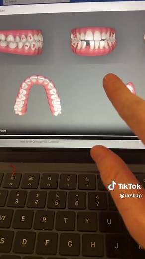 Managing Extra Teeth: Extraction vs. IPR Decisions