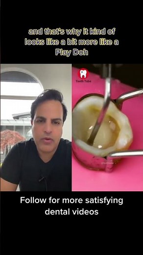 Dentistry explained:Huge cavity filled in the tooth#Dentist #Dentistry #Tooth #Cavity #filling