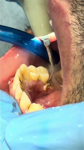Gumline Tartar Removal | Satisfying Dental Precision