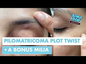 The Pilomatricoma Plot Twist + Bonus Milia Pop 💥