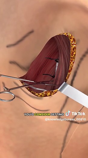 How Heart Pacemaker Works? (3D Animation) #pacemaker #pacemakers #heartpacemaker #pacemakerdevice #heartattack #hearttreatment #heartissues #medical3danimation #3dmedicalanimation