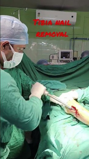 Tibia nail removal | Tibia bone fracture| Leg bone rod removal | Bone rod removal #bone #fracture
