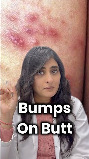 Butt acne | butt pimples| dark spots on back