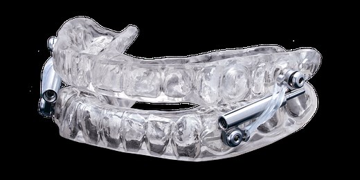 Silent Nite with Glidewell Hinge — Oral Appliance for Sleep Apnea