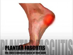 Plantar Fasciitis Diagnosis & Treatment