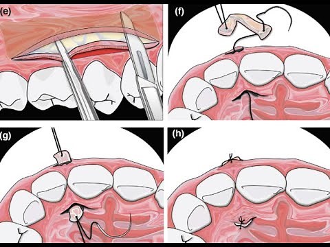Papilla Reconstruction part 5 of 5, Surgical techniques