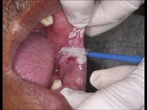 ORAL EXFOLIATIVE CYTOLOGY/ ORAL CYTOLOGY TECHNIQUE/ ORAL SCREENING PROCEDURE/ ORAL CANCER SCREENING
