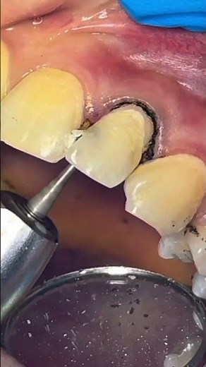 Oddly Satisfying Cavity Cleaning | Dentist ASMR