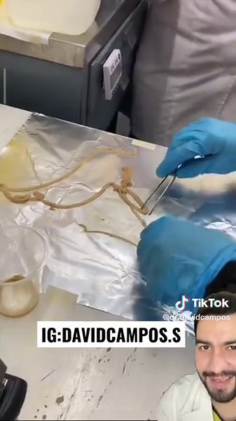 Tipos de Tenia: Información sobre este Parasito Común
