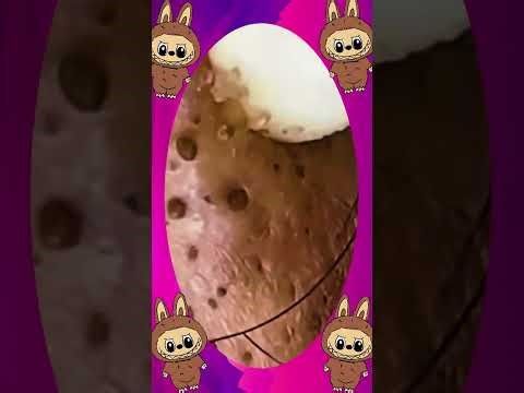 Blackheads Removal #089 | Acne Treatment and Very Satisfying Satisfying Pimple pop #blackheads