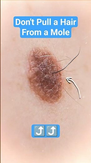 Don’t Pull That Mole Hair!