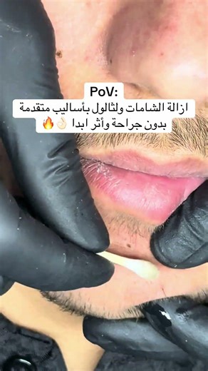 بلازمابن لا ازالة الشامات #ايكسبلور #تجميل #skincare #ترند #النظافه #تيك_توك #مايكاب