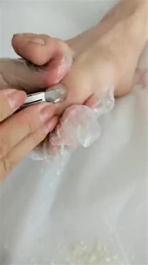 24K views · 60 reactions | #Reels Top Removal & Cutting Old & Long Big Ingrown Toenail DIY Designs Art Toenail Roomb VCD54 | Atlas Professional Risk Management | Facebook