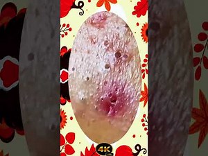 Blackheads Removal | Acne Treatment and Very Satisfying Satisfying Pimple pop #blackheads