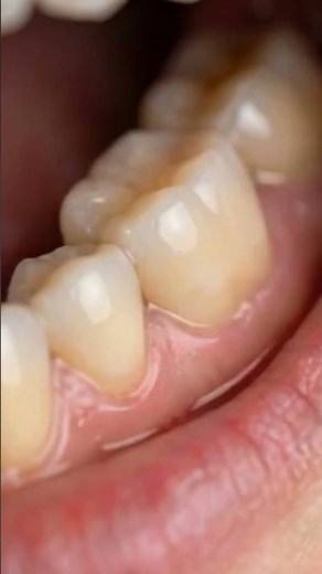 Satisfying Heavy Tartar Removal & Teeth Restoration! ✨