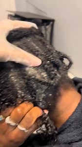 286K views · 499 reactions | Scalp psoriasis is a common skin disorder that causes red flaky patches on the scalp often accompanied by itching burning and soreness Cleaning the scalp is an essential part of managing psoriasis symptoms I recommend she visits every week but her schedule will only allow her to come every two weeks psoriasisawareness scalppsoriasis scalpcare thr1ve healthyhairjourney hairtokThr1ve | Meneawara Precious Barilunanee | Facebook