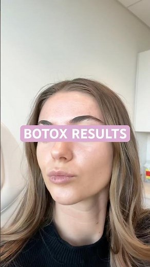Botox before and after 2 weeks #botox #dysport #botoxresults #beforeandafter #botoxbrowlift