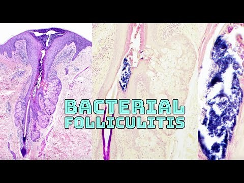 Bacterial folliculitis under microscope (inflamed hair follicle w/ Gram positive cocci) histology