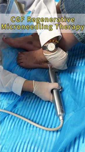 CGF Regenerative Microneedling Therapy
