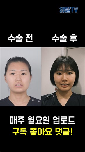유간호사 수술 전~수술 후 100일간의 붓기변화!! #양악수술 #구강악안면외과 #돌출입 #부정교합 #브이로그 #vlog #간호사