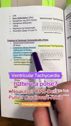 Understanding Ventricular Tachycardia and Pulse Detection