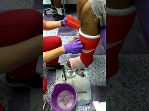 Short leg cast application