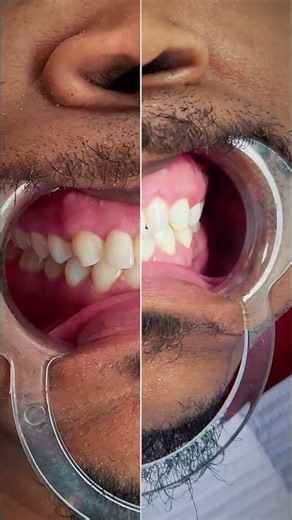 Real Invisalign Smile Transfor
