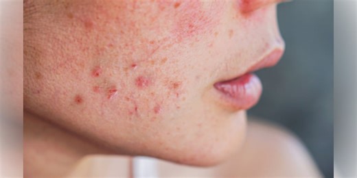 Dermatologist explains different ways to treat acne based on severity