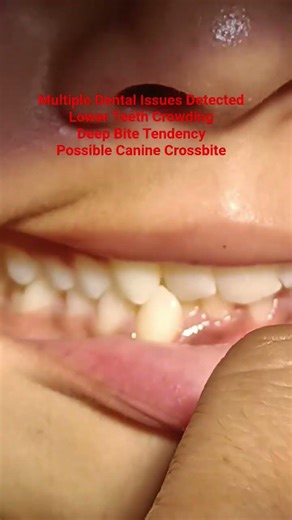 Can you spot all theproblems in this smile ? DeepBite,cross bite, Crowding of teeth #thedentalguru