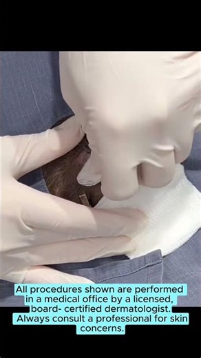 Did you know that 90% of pilar cysts occur in the scalp because they start in the hair follicle?