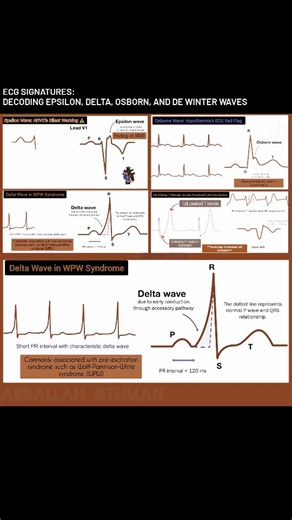 ECG Signatures; Decoding Epsilon, Delta, Osborn, and De Winter Waves. key waveforms: Epsilon Wave in ARVC (seen in V1-V2) signals delayed RV depolarization, a hallmark of fibrofatty replacement. Delta Wave in WPW syndrome (PR