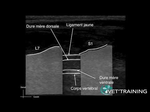 L'anésthésie péridurale assistée par échographie