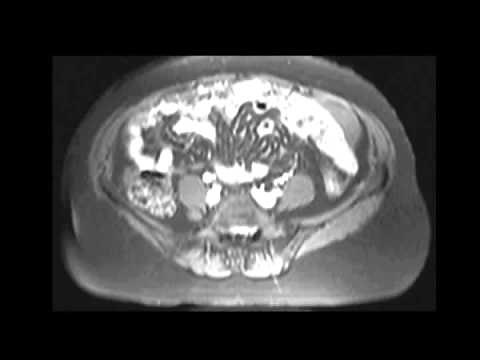 Primary peritoneal carcinomatosis