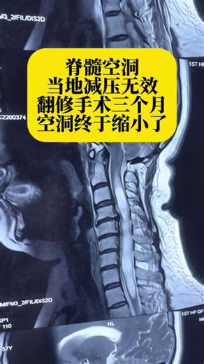 脊髓空洞当地减压无效翻修手术三个月空洞终于缩小了 #脊髓空洞 #脊髓空洞症 #小脑扁桃体下疝 #手麻 #肌肉萎缩