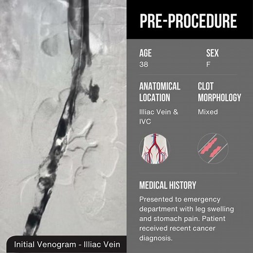 Thrombus in the Iliac Vein and IVC | Symphony™ Thrombectomy System