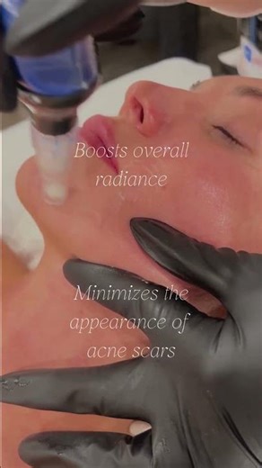 SkinPen Microneedling