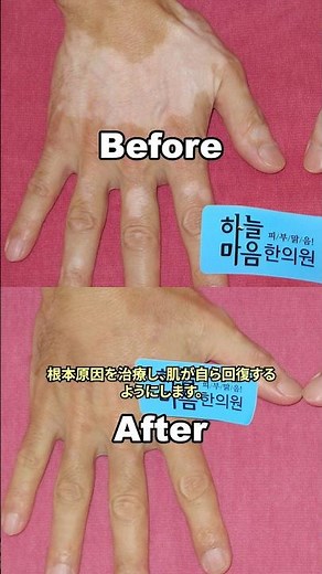 脱ステロイドで白斑症を治す。その方法と症例