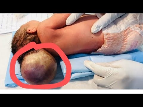 Baby with Two Heads 👶🥺 Rare Birth Case | Medical Explanation & Awareness 🤲🍼#cutebaby #nicu #baby